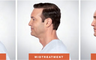 Kybella Men Before After
