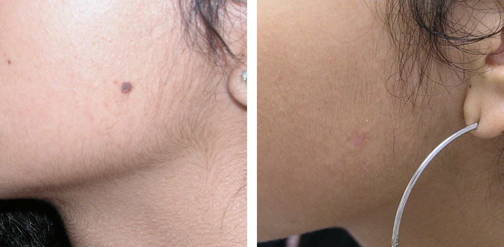 Utilizing 7 Mole Removal Strategies Like The Professionals