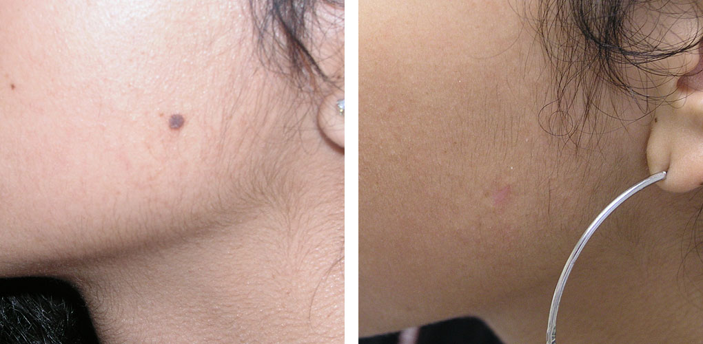 Mole Removal Cash Experiment