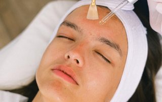 chemical peel