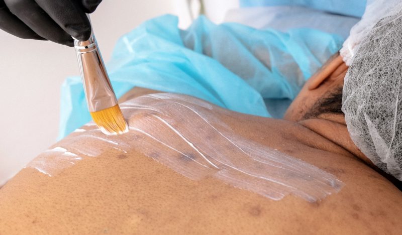 back acne facial