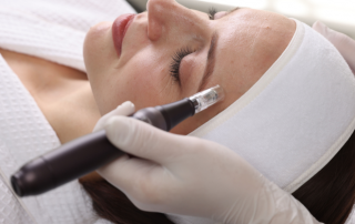 microneedling