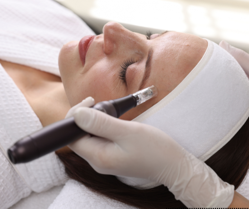 microneedling
