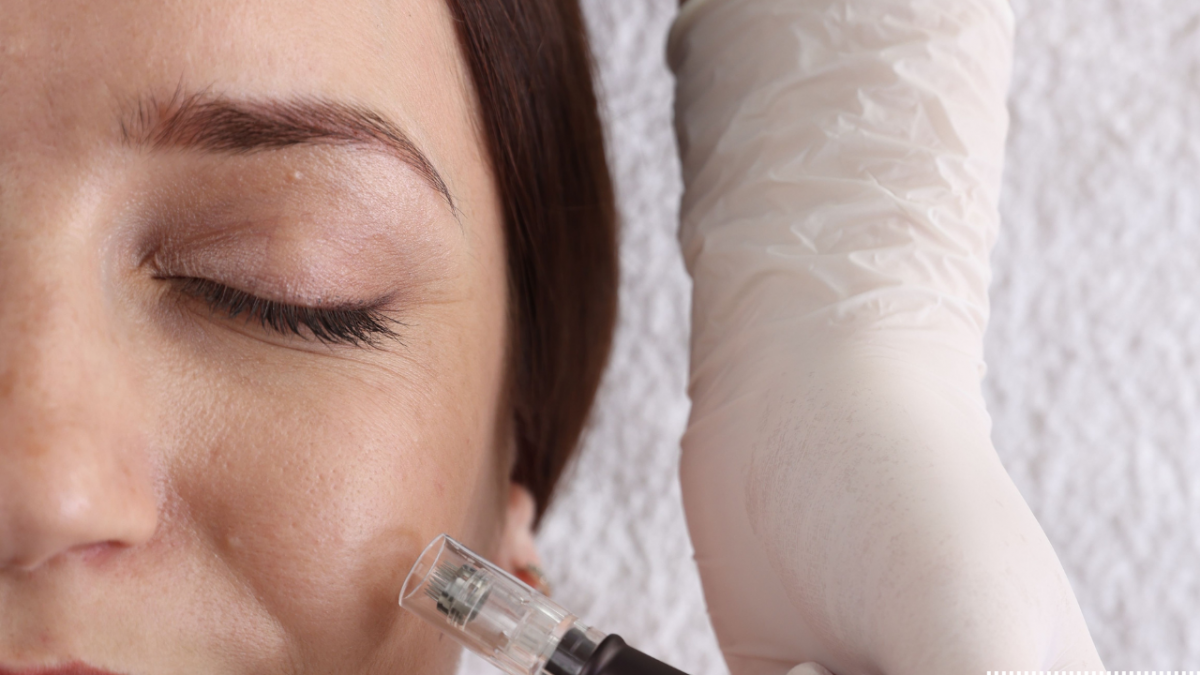 microneedling treatment