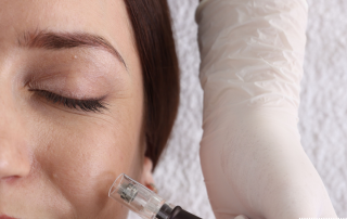 microneedling treatment